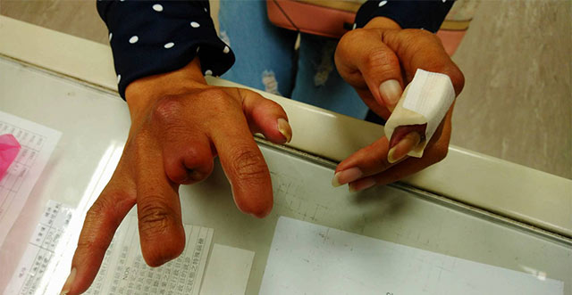 門諾心臟外科醫師黃振銘柏格氏症戒菸就能及早治療