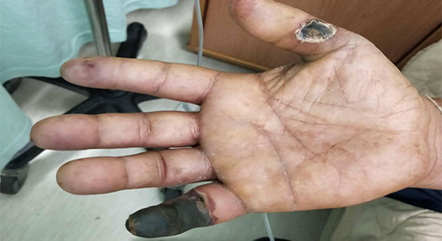 門諾心臟外科醫師黃振銘柏格氏症戒菸就能及早治療